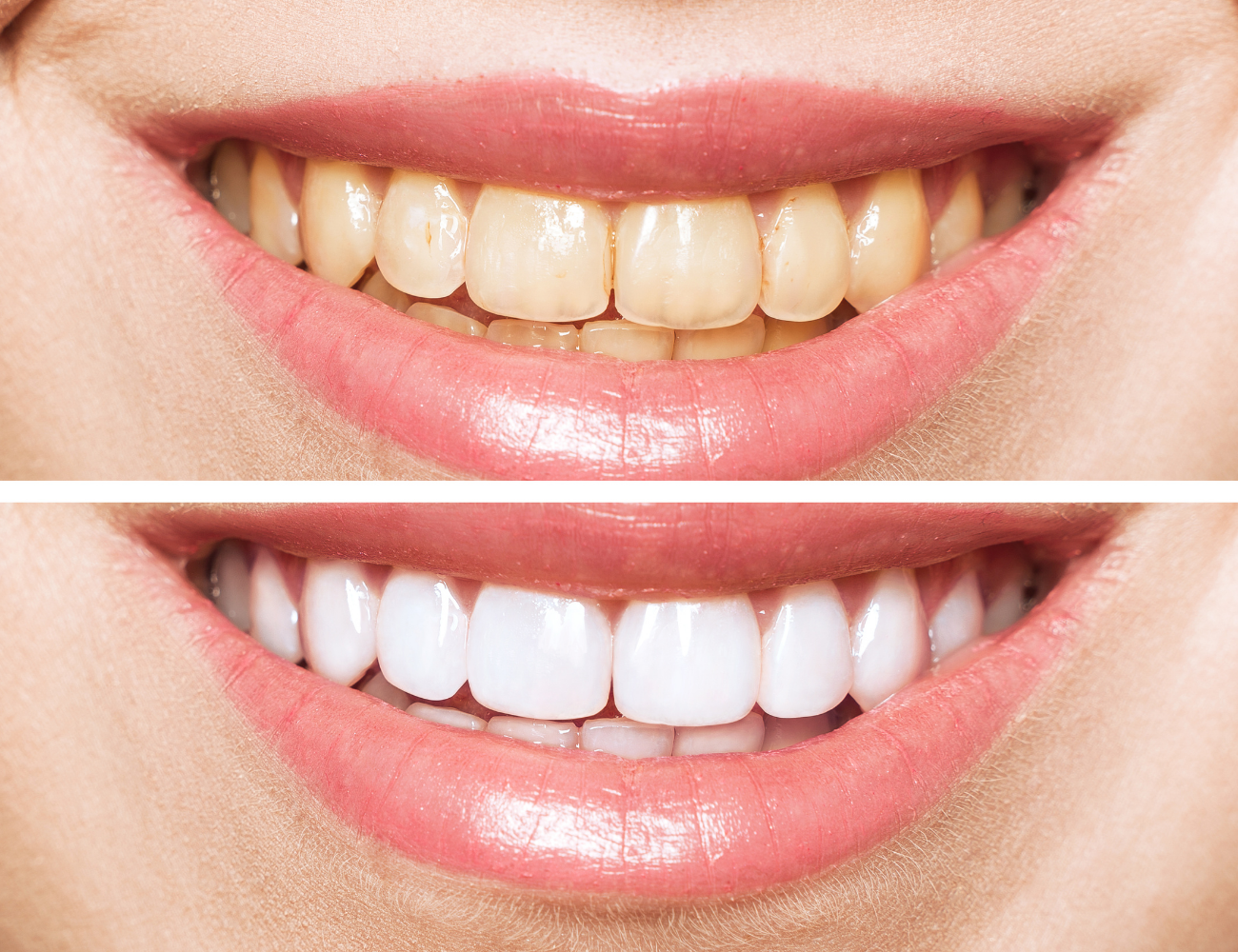 Zygomatic Implants Result